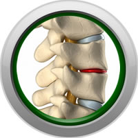 Spinal Decompression FAQ
